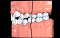 Teeth classification animated illustration for Orthodontics: Class I Crowding