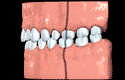 Teeth classification animated illustration for Orthodontics: Class I Spacing