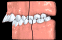 Teeth classification animated illustration for Orthodontics: Class II Division I
