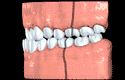 Teeth classification animated illustration for Orthodontics: Class III Dental