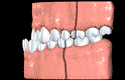 Teeth classification animated illustration for Orthodontics: Class III Skeleton