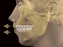 Animated face and teeth classification illustration: Maxillary-Mandibular Dental Protrusion