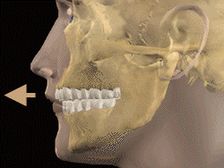 Animated face and teeth classification illustration: Maxillary Dental Protrusion