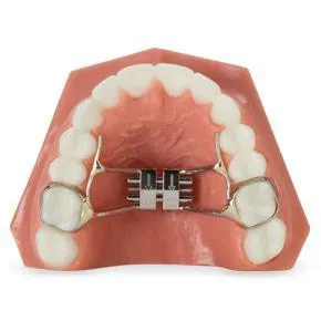 Photo: Rapid Palatal Expander appliance