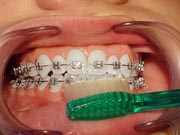 Photo: Brushing with Braces, exterior of teeth