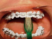 Photo: Brushing with Braces, interior of teeth