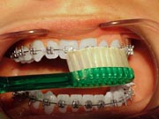 Photo: Orthodontic Tooth Brushing, below braces