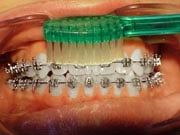 Photo: Orthodontic Tooth Brushing, above braces