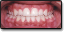 After photo: Crossbite resolved with straight teeth and even bite, case study 1
