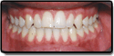 After photo: Crossbite resolved with straight teeth and even bite, case study 2