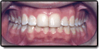 After photo: Crowding and Spacing in Upper Teeth, case study 1
