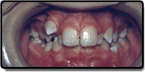 Before photo: Crowding and Spacing in Upper Teeth, case study 1