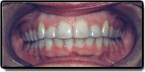 After photo: Crowding and Spacing in Upper Teeth, case study 2