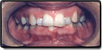 Before photo: Crowding and Spacing in Upper Teeth, case study 2