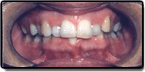 Before photo: Crowding and Spacing in Upper Teeth, case study 2