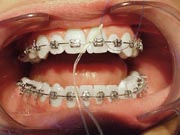 Photo: Orthodontic Flossing around Braces