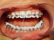  Photo: Flossing gum line and around braces
