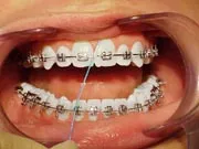  Photo: Flossing gum line and around braces