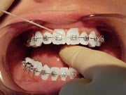 Photo: Orthodontic Flossing for each tooth