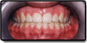 After Photo: Impacted tooth solution in Somerville NJ
