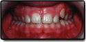 Before Photo: Impacted Upper Eye Tooth