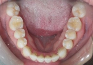 Photo of lower jaw orthodontic retainer
