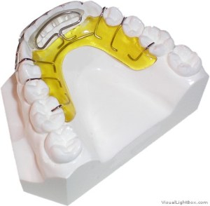Photo: Spring Aligner retainer