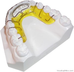 Photo: Spring Aligner retainer