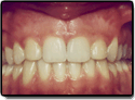 After Photo: aligned and present teeth inInterior Photo: Somerville NJ