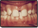 Before Photo: Missing Teeth in Somerville NJ