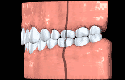 Teeth classification illustration for Orthodontics: Class I Normal