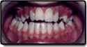 Before photo: Openbite case study
