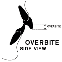Overbite side view illustration