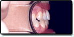 After photo: Underbite corrected, with upper teeth positioned in front of the lower teeth