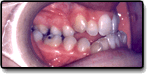 Before photo: Underbite Before Photo