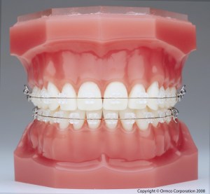 Photo of a model of upper and lower teeth, gums, and jaws