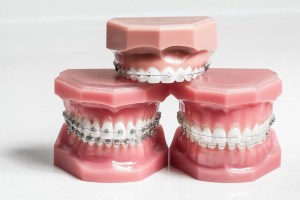 Photos: Multiple options for dental braces on acrylic teeth displays
