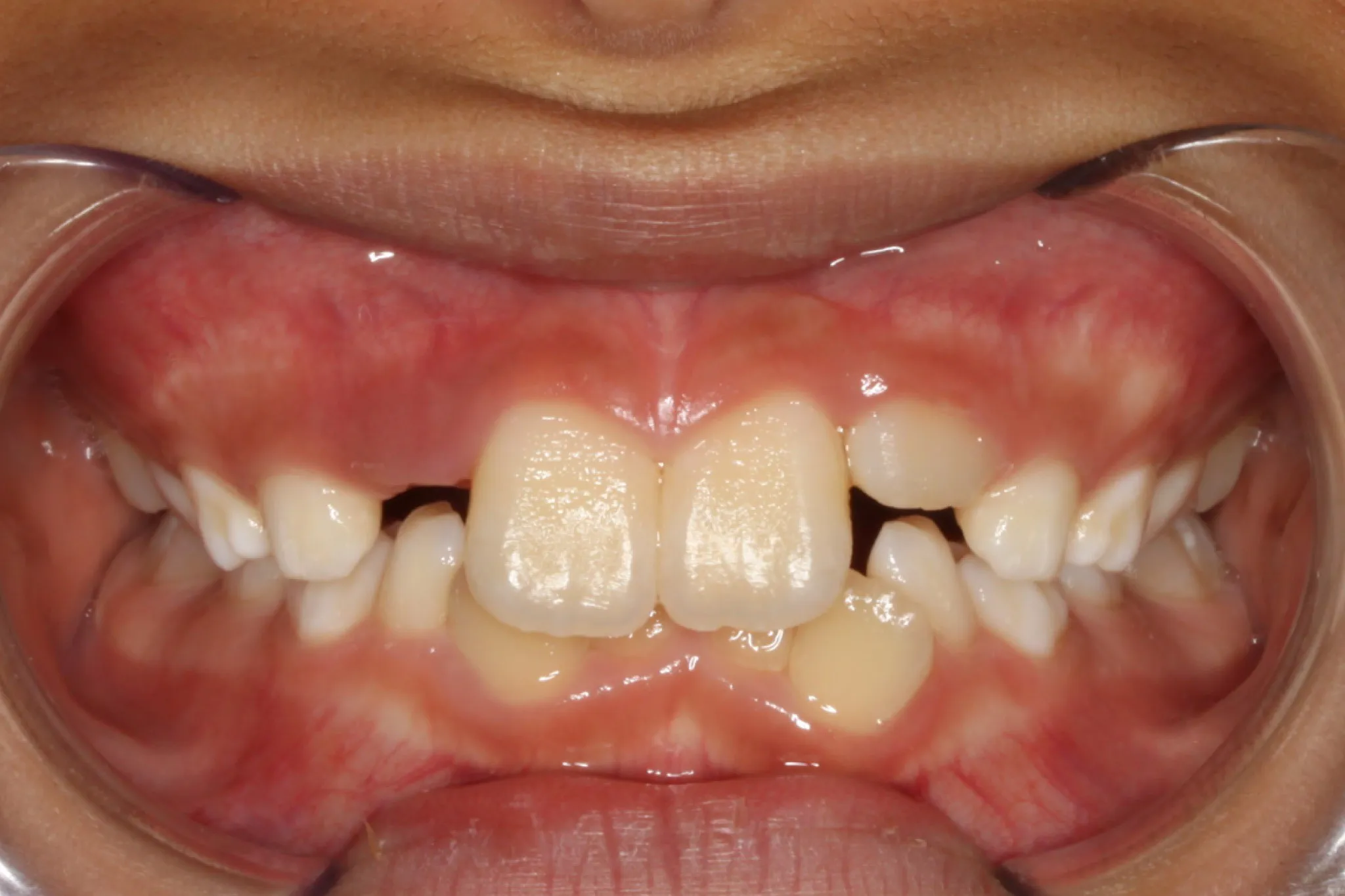 Before photo: Partially erupted, crooked, and missing upper teeth