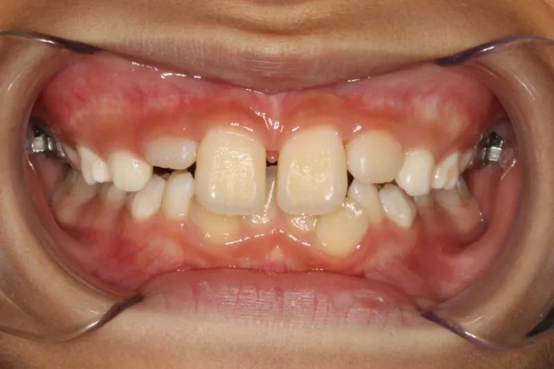 Before photo: Partially erupted and gappy upper teeth