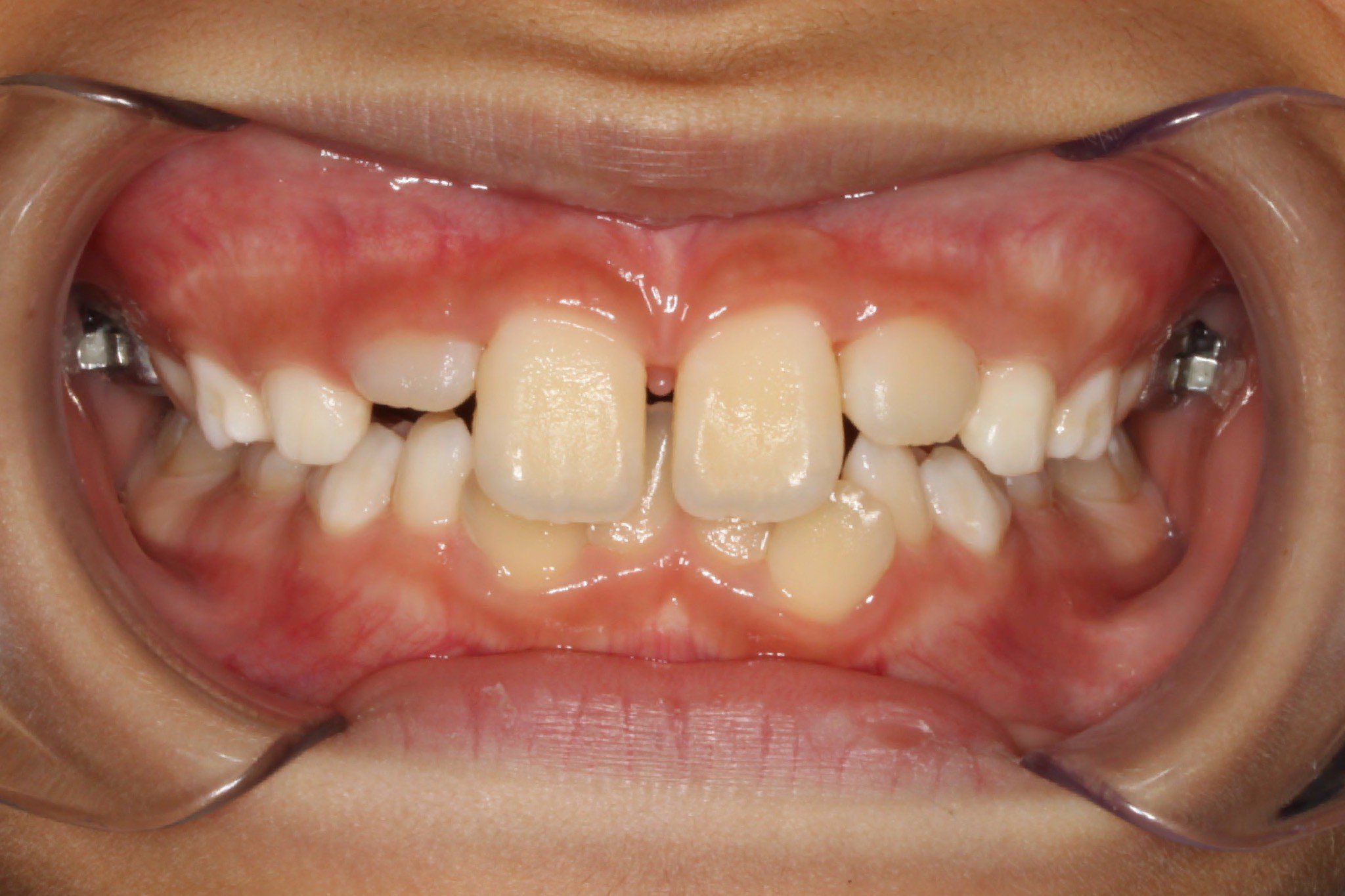 Before photo: Partially erupted and gappy upper teeth