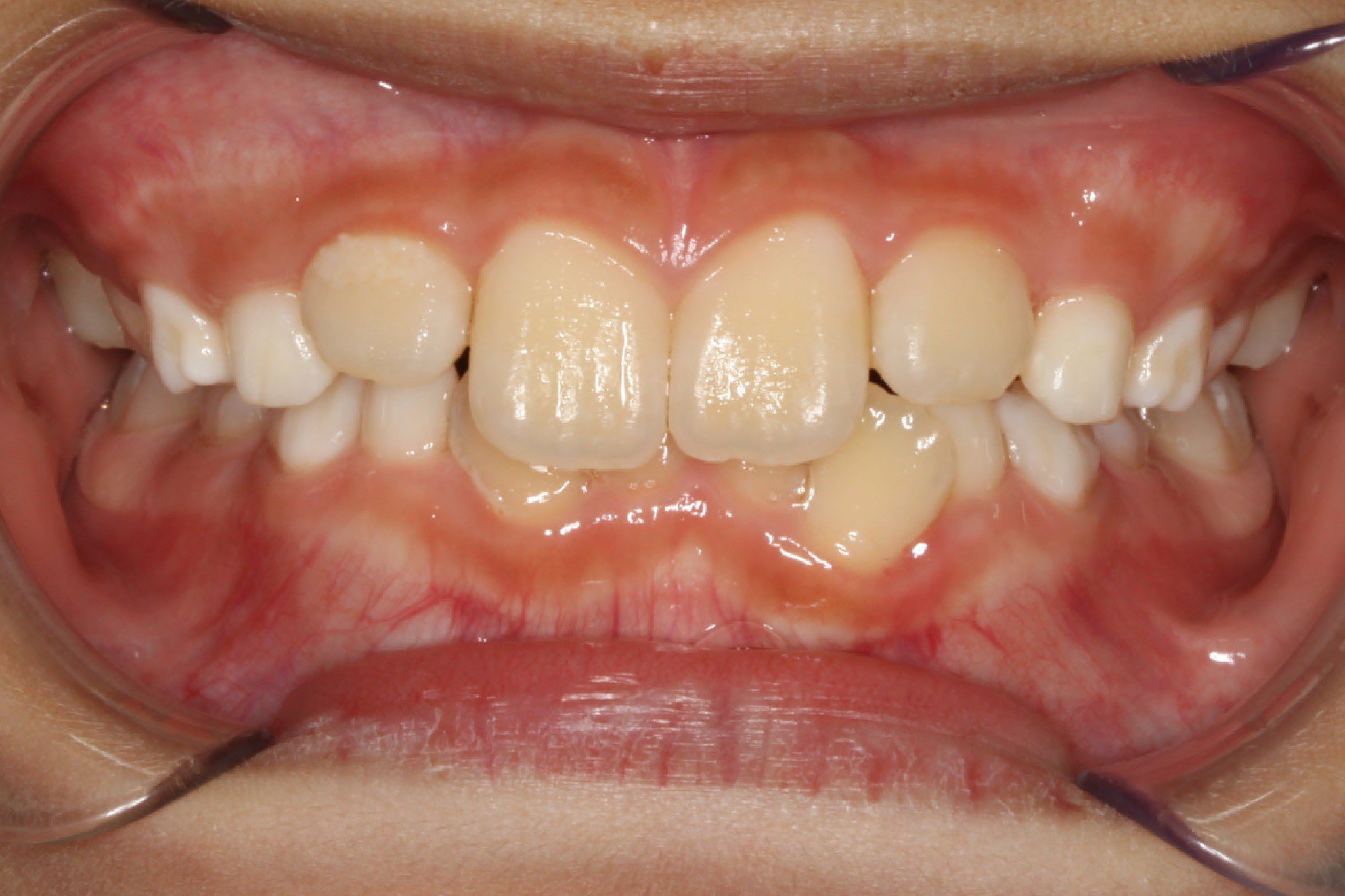After photo: Fully erupted, straightened upper teeth