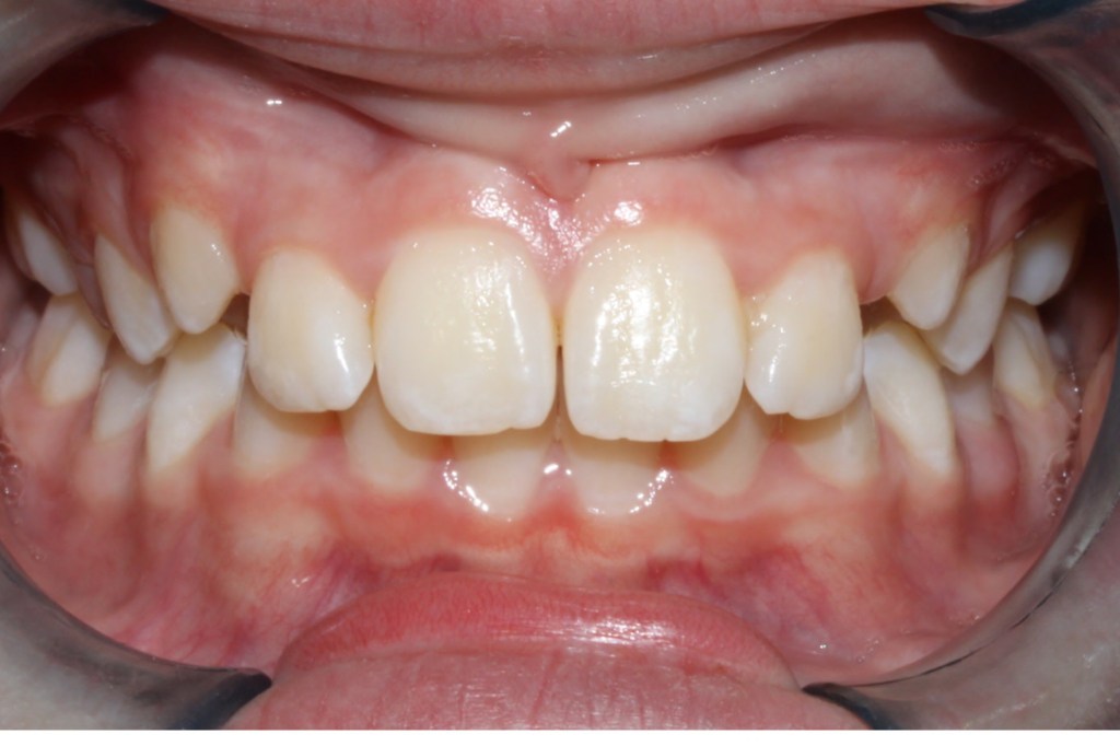 Before photo: Partially erupted upper teeth with overbite