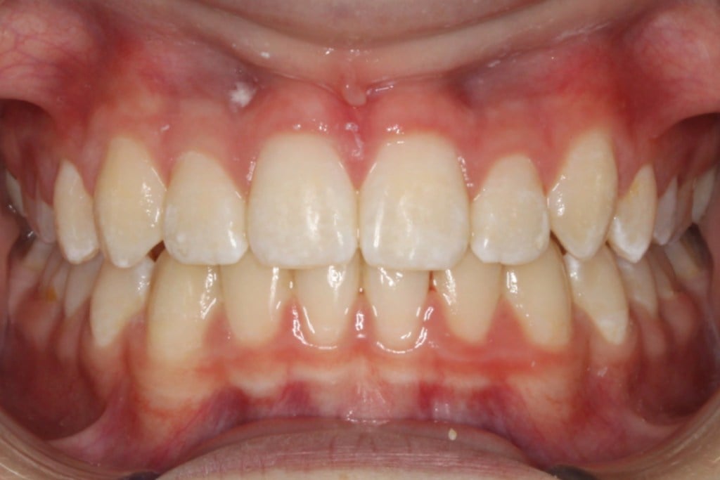 After photo: Evenly spaced teeth and bite correction