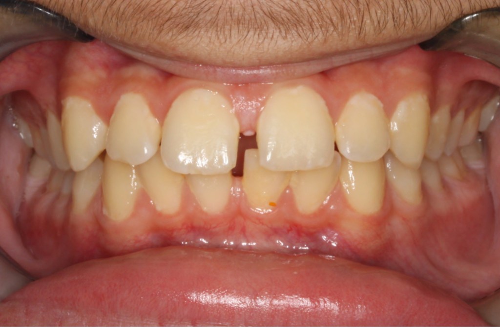 Before Photo: Spacing issues with gap between front upper teeth
