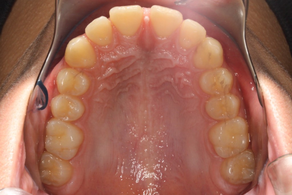 Before Photo: Gap between upper front teeth looking up and inside