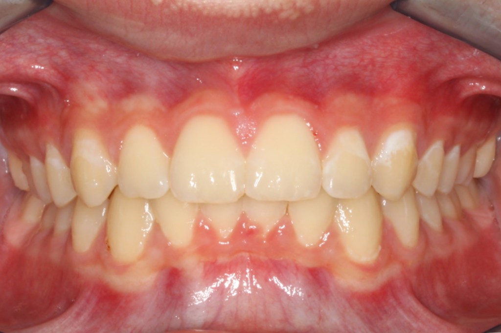 After photo: Evenly spaced upper teeth without gaps