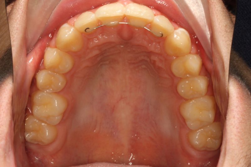 After photo: Evenly spaced upper front teeth, looking up and inside