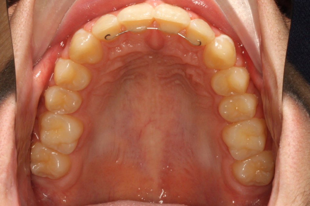 After photo: Evenly spaced upper front teeth, looking up and inside