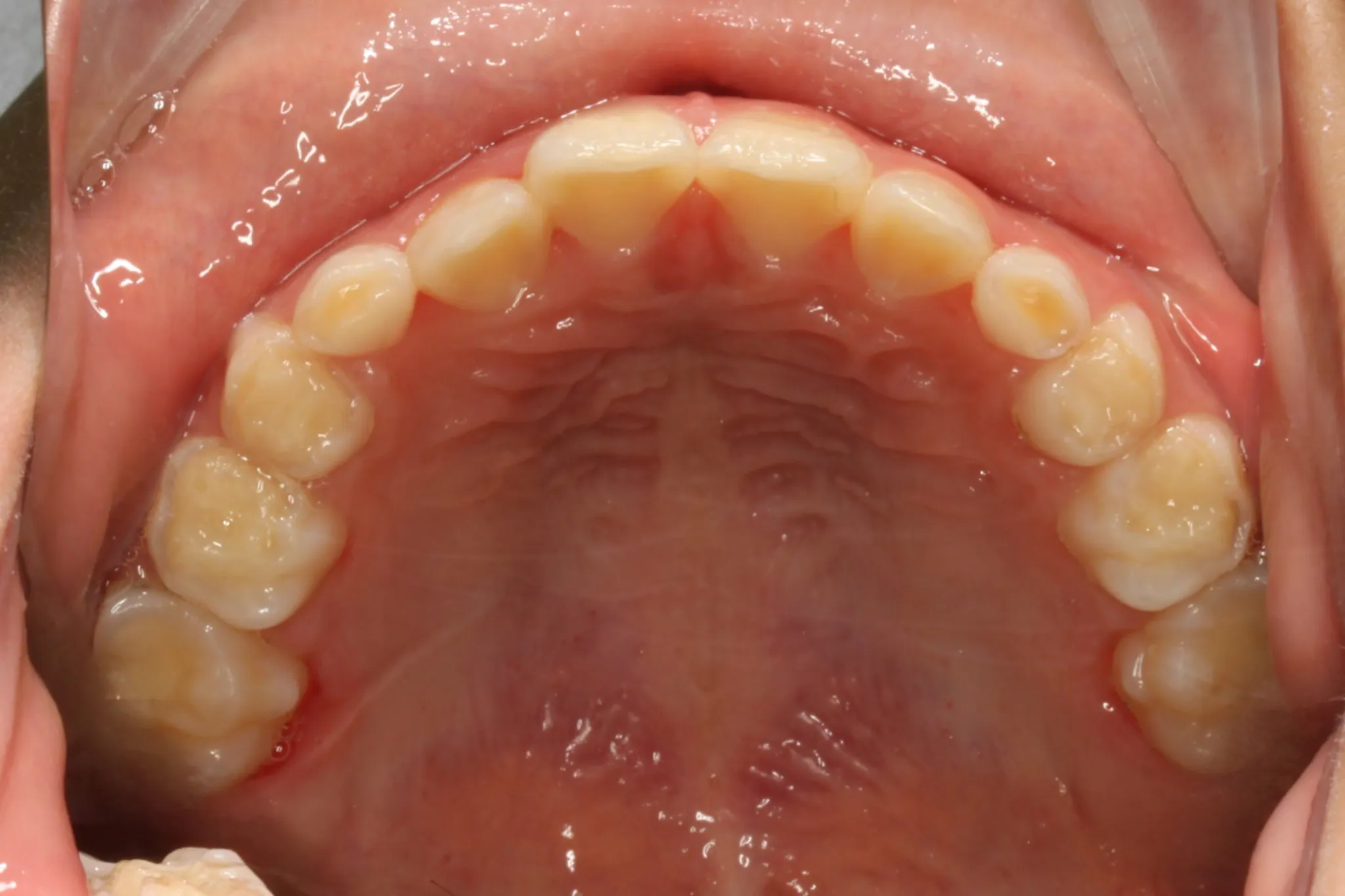After inside photo: Straightened front teeth
