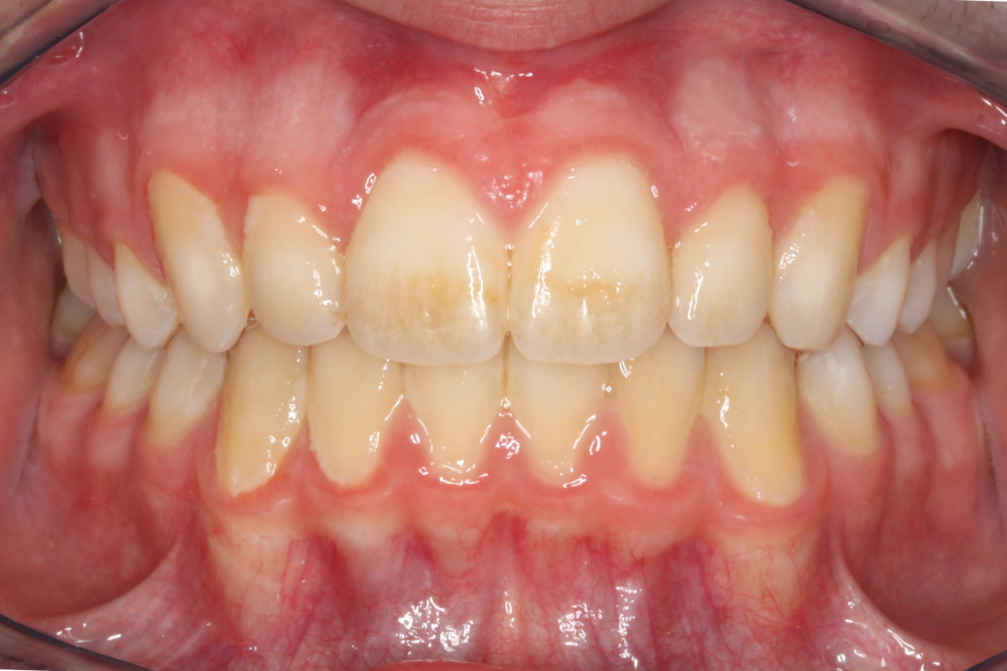 After photo (front view of teeth): Dental Expanders & Braces for Severe Crowding, Case Study #1